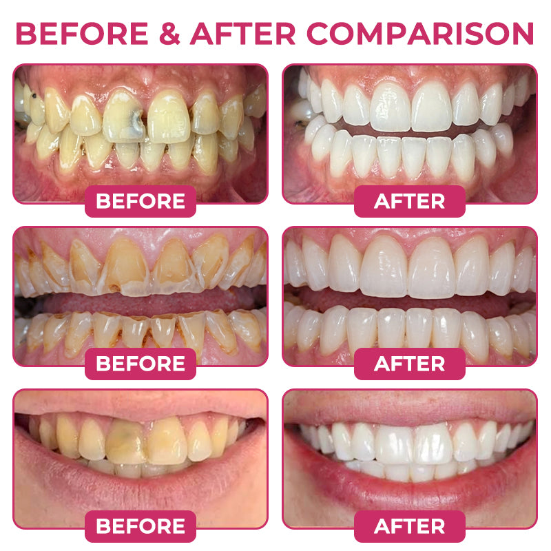 Kervalon® DenPerm Cavity-Repair Natural Enamel Filling Gel