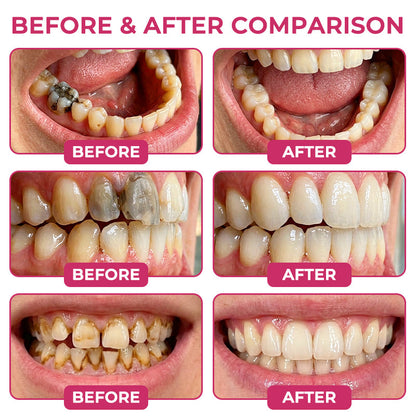 Kervalon® DenPerm Cavity-Repair Natural Enamel Filling Gel